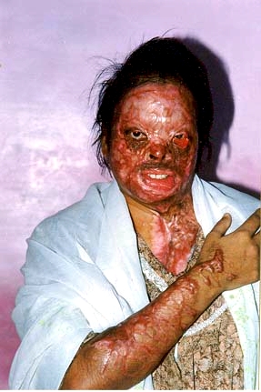 Shanti, a victim of an acid attack by her husband: http://www.geocities.com/odanadisevatrust/pa4.html
