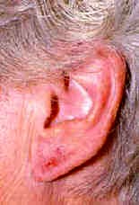 Nickel allergy on the lobe due to contact with nickel