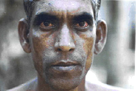 Eye disease caused by arsenic (photo courtesy: http://worldbank.org/)