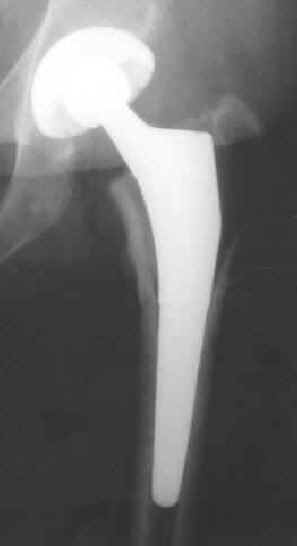 Titanium hip implant